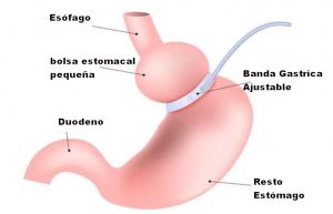 Banda gástrica virtual: una alternativa segura a los procedimientos quirúrgicos